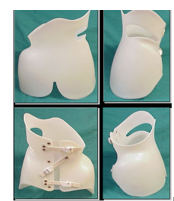 脊柱側(cè)彎支具