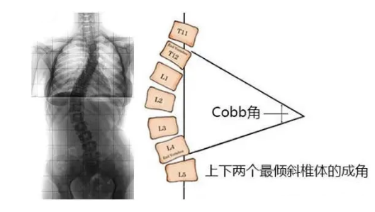 脊柱側(cè)彎角度怎么測量？