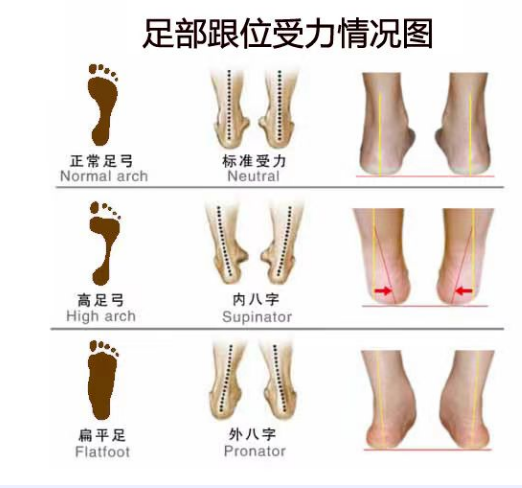 扁平足和脊柱側(cè)彎之間有關(guān)聯(lián)嗎？