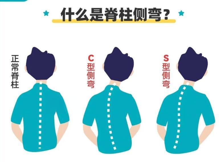脊柱側(cè)彎與自查
