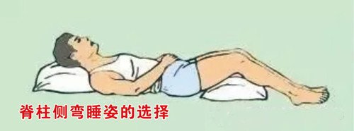 睡姿不正確會對脊柱側彎產生影響嗎？