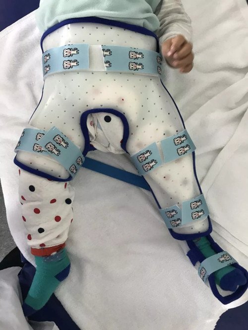 低溫板材在下肢骨折上的應(yīng)用