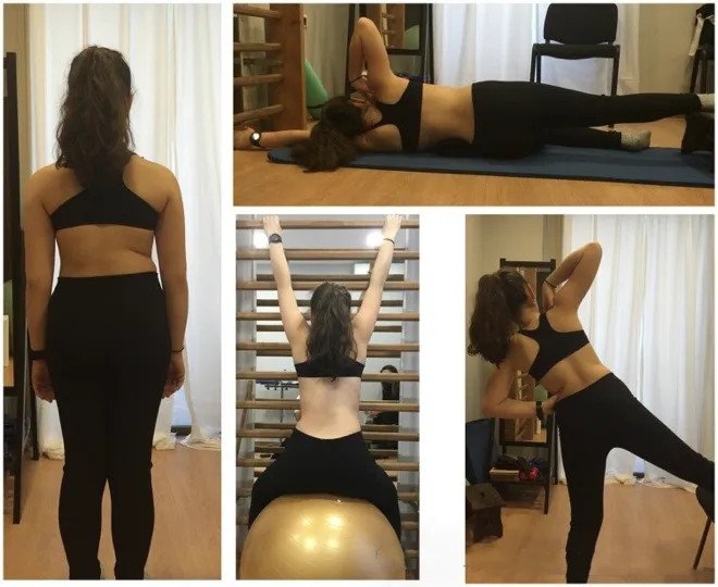 佩戴脊柱側(cè)彎矯形器后的運(yùn)動(dòng)治療