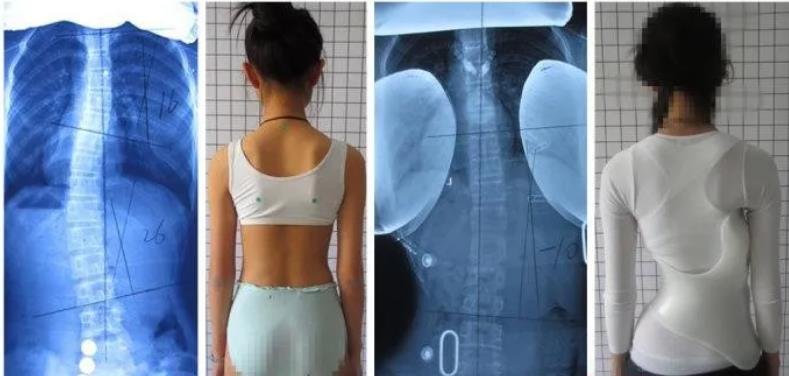 脊柱側(cè)彎支具市場(chǎng)價(jià)格調(diào)研