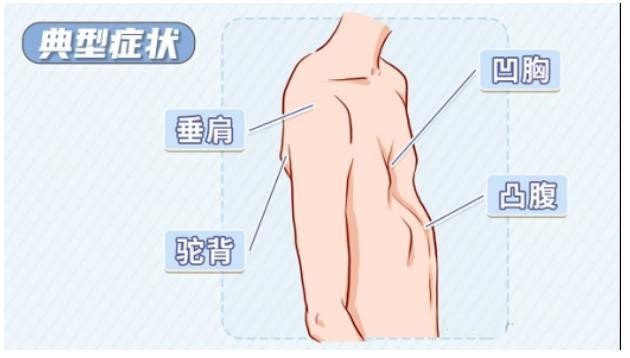 漏斗胸怎么矯正？