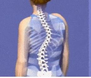 成人脊柱側(cè)彎怎么辦？